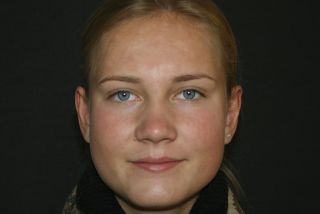 Ohren anlegen Bild nach OP 7